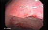 Tubulo - Villous Rectal Adenoma - Endoscopy (32 of 35)