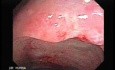 Tubulo - Villous Rectal Adenoma - Endoscopy (32 of 35)