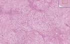 Fatty change - Histopathology - Liver