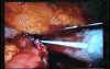 Jejunal Gastrointestinal Stromal tumor (GIST) (43 of 86)