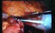 Jejunal Gastrointestinal Stromal tumor (GIST) (43 of 86)