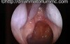 Right Inferior Meatal Antrostomy with Antral Polyps