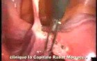 Laparoscopic Treatment Of Uterine Retroversion In Case Of Chronic Pelvic Pain