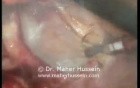 L Low Anterior Colon Resection - Laparoscopic Approach