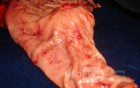 Diffuse Adenocarcinoma with signet ring cells (11 of 18)