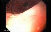 Primary Gastric Lymphoma Following Kidney Transplantation - Display of the Ulcers