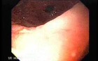 Primary Gastric Lymphoma Following Kidney Transplantation - Display of the Ulcers
