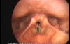 Arytenoid Mass