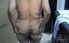 Extensive Acanthosis Nigricans due to rectal carcinoma (3 of 7)
