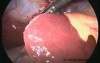 Laparoscopic Cholecystectomy 