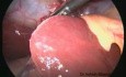 Laparoscopic Cholecystectomy 