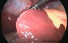 Laparoscopic Cholecystectomy 