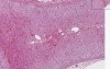 Adrenal - Cortical Adenoma