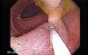 Colonoscopic Polypectomy (7 of 18)