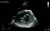 Mitral Valve Regurgitation