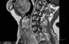 Esophageal Squamous Cell Carcinoma of the the upper third of the Esophagus that invades the subglotic (7 of 8)
