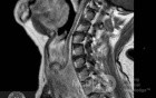 Esophageal Squamous Cell Carcinoma of the the upper third of the Esophagus that invades the subglotic (7 of 8)