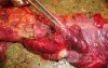 Multiple Rectal Ulcers (80 of 110)