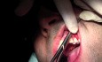 Gingival Grafting #11-12