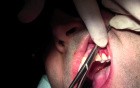 Gingival Grafting #11-12