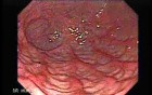 Acute Gastritis. Reddened Gastric Folds