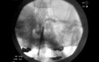 Baloon Sinuplasty 