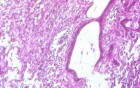 Rectal Adenocarcinoma (7 of 7)
