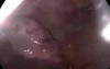 Ectopic Pregnancy