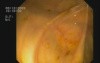 Enterobiosis In Colonoscopy