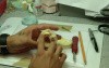 Bar Supported Maxillary Denture - Part 1 - Discussion About Treatment