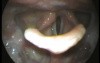Palsy of The Vocal Cords