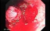 Tubulo - Villous Rectal Adenoma - Endoscopy (10 of 35)