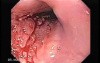 Esophageal Squamous Cell Carcinoma (2 of 2 )