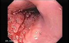 Esophageal Squamous Cell Carcinoma (2 of 2 )