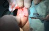 Otoplasty auriculoplasty in prominent ears - Scarless Method