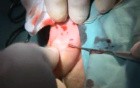 Otoplasty auriculoplasty in prominent ears - Scarless Method