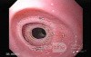 Congenital Esophageal Rings - 17 Years-Old Female