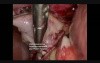 Laparoscopic Cholecystectomy - Gangrene and Empyema of the Gall Bladder
