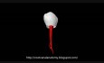 Taurodontism: Mandibular First Premolar
