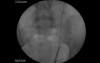 Ureteral Stones - Ureteroscopy and Laser Lithotripsy
