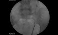 Ureteral Stones - Ureteroscopy and Laser Lithotripsy