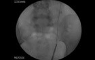 Ureteral Stones - Ureteroscopy and Laser Lithotripsy