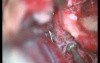 Right Facial Nerve Transposition - Posterior Rerouting