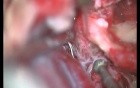 Right Facial Nerve Transposition - Posterior Rerouting