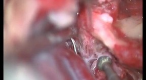 Right Facial Nerve Transposition - Posterior Rerouting