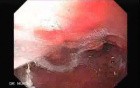 Scirrhous Gastric Carcinoma - Endoscopy (12 of 47)