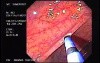 Argon Plasma Coagulation
