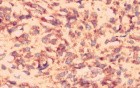 Gastrointestinal Stromal tumor (GIST) (61 of 65)