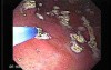 Watermelon Stomach (4 of 7) - Treatment with Argon Plasma Coagulator (APC)