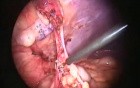 Laparoscopic Appendectomy (Mukunda's Hangman' Technique)